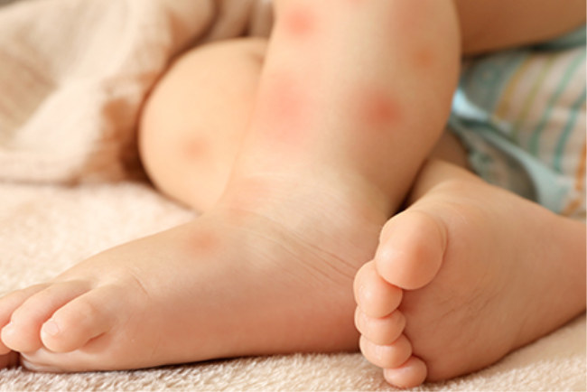 ילד קטן סובל מפריחה בעור שעלולה להיות עקב אלרגיה למזון